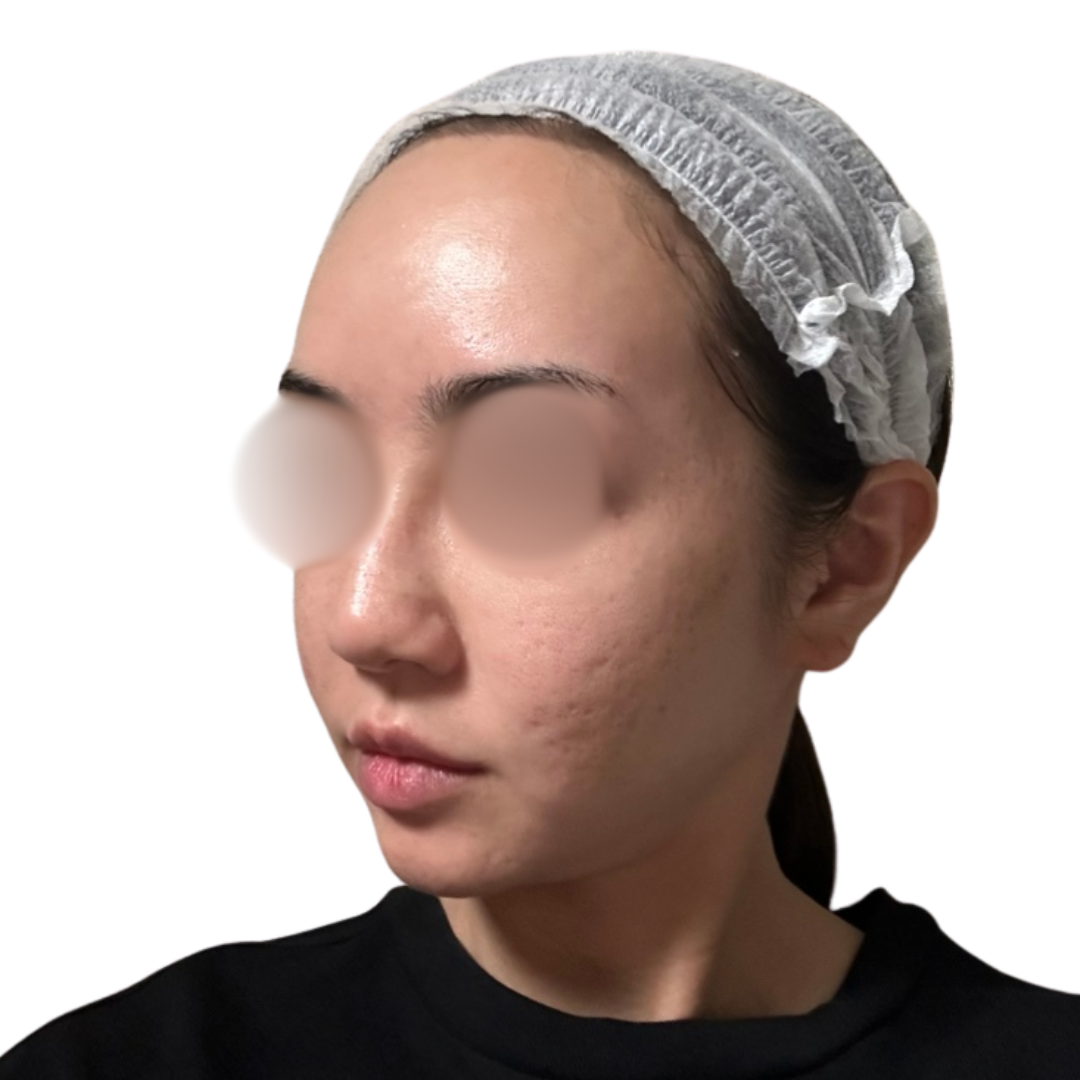 サブシジョン（クレーター治療）